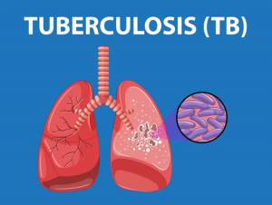 India’s Battle Against Tuberculosis