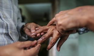 Combating Discrimination in India: Imperative for Removing Anti-Leprosy Provisions