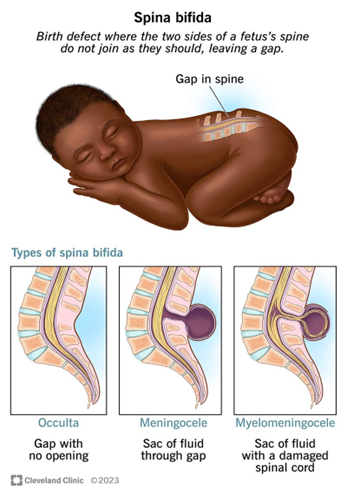 Spina Bifida, Neural Tube Defects, Folic Acid Fortification, Maternal Health, Public Health India, Congenital Disorders, NTD Prevention, Nutrition Policy, Healthcare India
